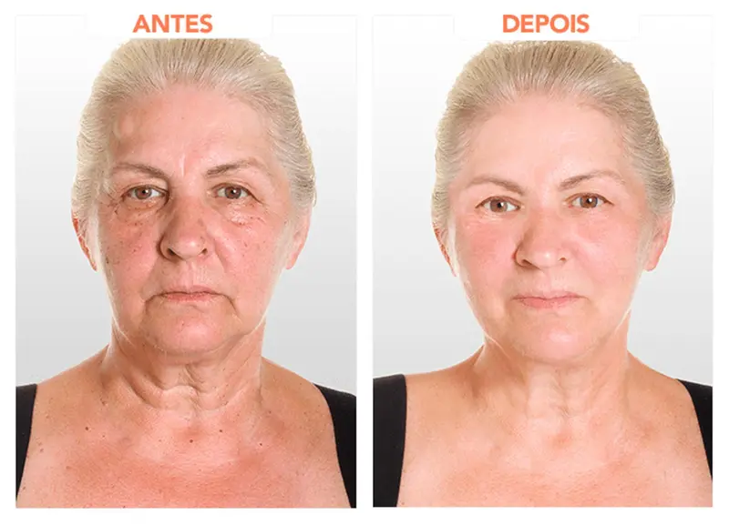 Resultado 5 - Rejuvenescimento facial completo